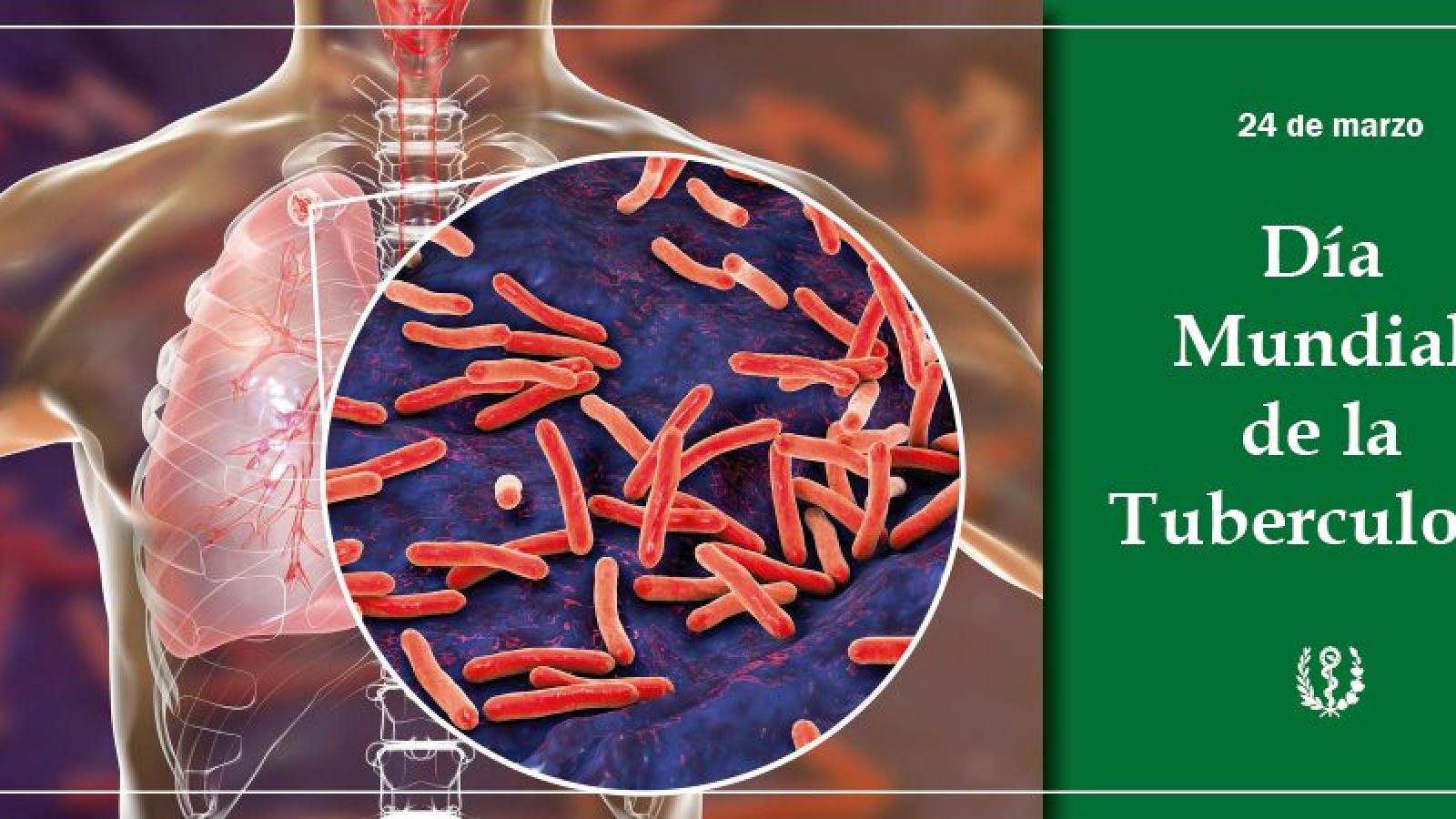 Tuberculosis: preguntas y respuestas