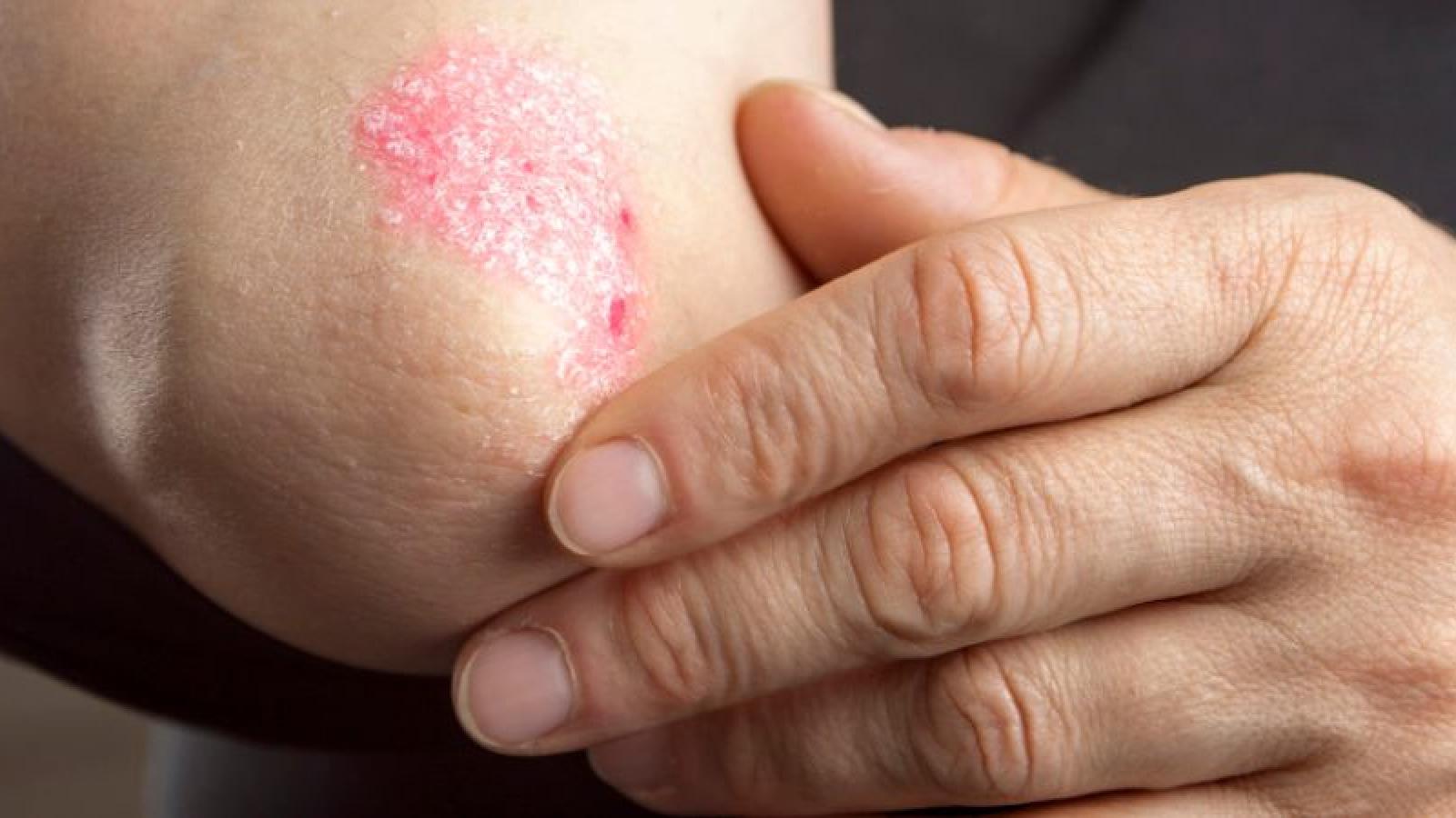 Día Mundial de la Psoriasis: ¿qué debes saber a propósito de la fecha?